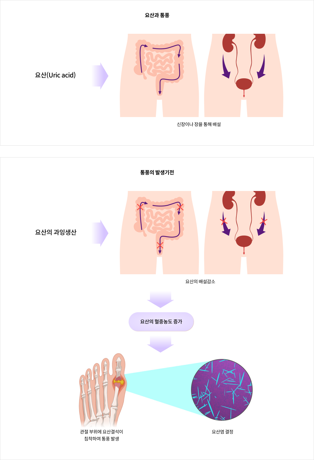 요산과 통풍