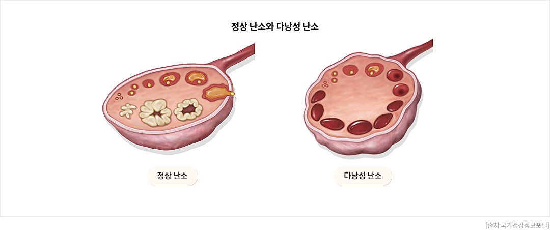 정상 난소와 다낭성 난소