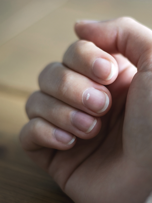 혹시 당신 손톱에 흰 반점이 있나요?