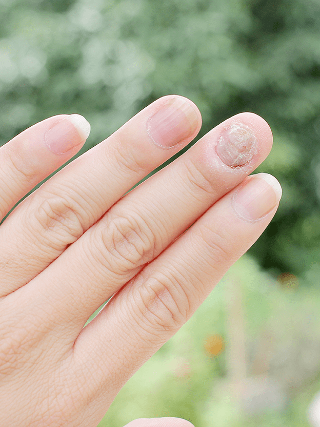 손톱에도 무좀이 생긴다고?