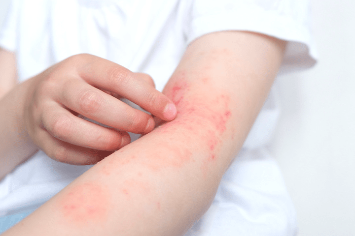 만성 염증성 피부 질환인 건선. 혹시 알고 계시나요?