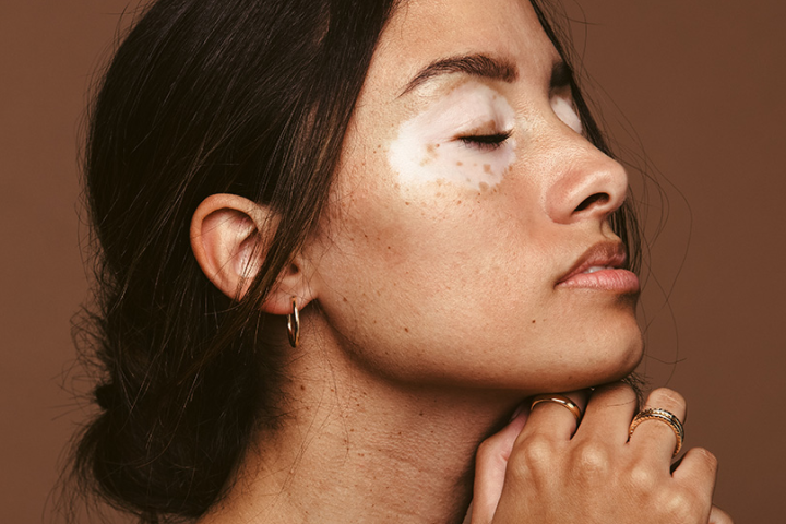 피부가 하얗게 변하는 질환??